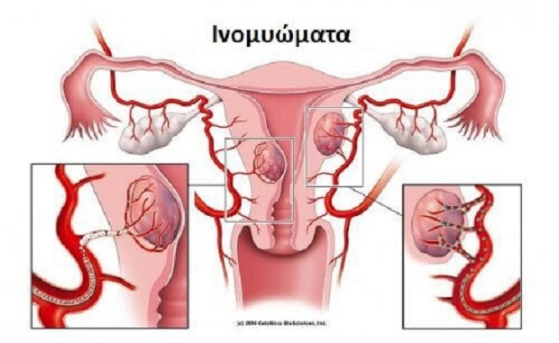 Πρωτοποριακή, αναίμακτη και ταχεία θεραπεία των ινομυωμάτων και της αδενομύωσης της μήτρας με κρυομυόλυση!